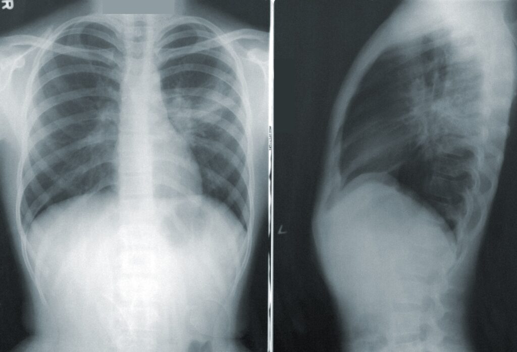 Internal Injuries From Car Accident