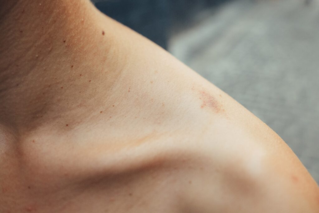 Shoulder Injuries from Car Accident