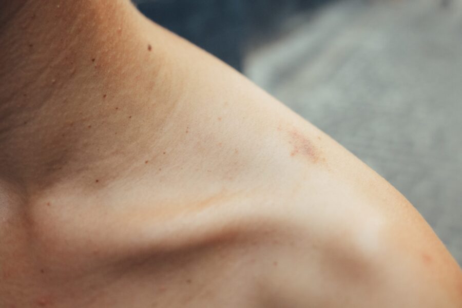 Shoulder Injuries from Car Accident